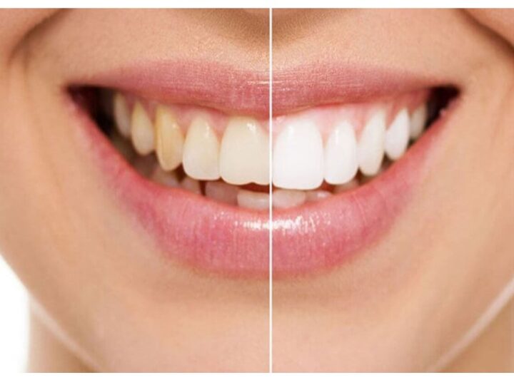 Is Teeth Whitening Good for Me?